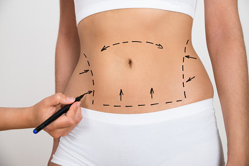 Liposuction Tucson