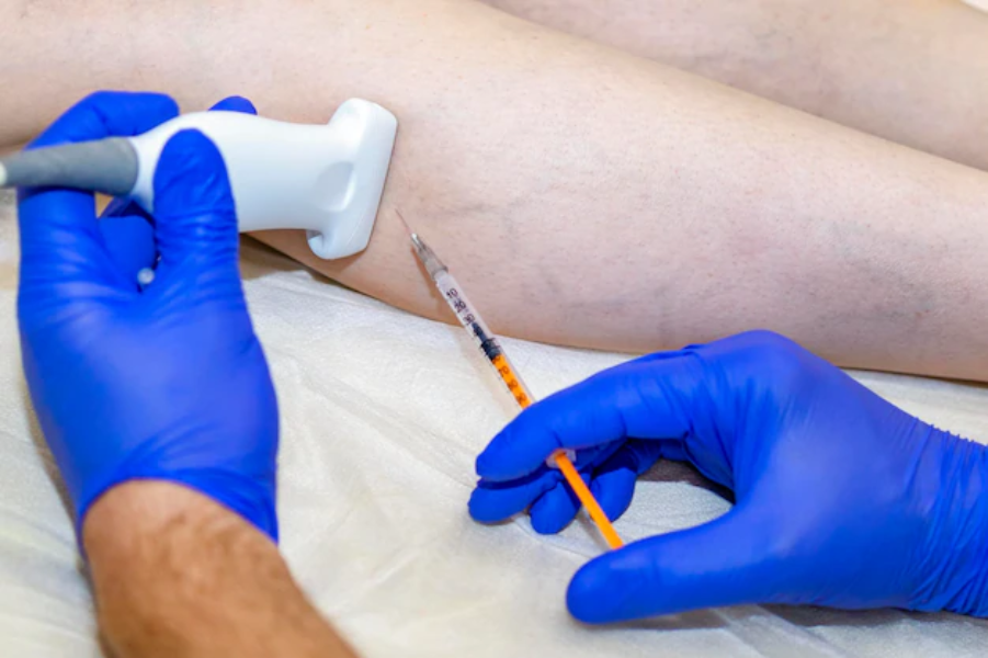 laser spider vein removal